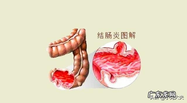 直肠炎和结肠炎有什么区别