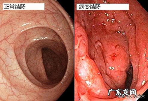 直肠炎和结肠炎有什么区别