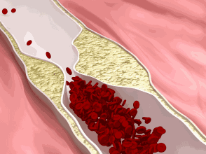 血脂高的人哪些食物不能吃饮食如何降血脂