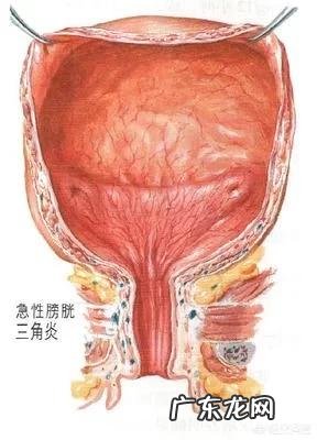 膀胱炎是什么原因导致的，如何预防膀胱炎呢