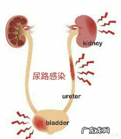 膀胱炎是什么原因导致的，如何预防膀胱炎呢