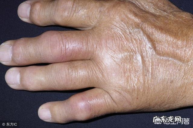 zhi疗痛风的药物会不会引发高血压