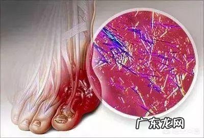 哪种食物,能有效降低尿酸,是痛风的天敌