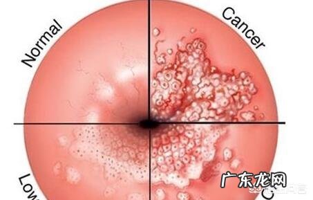 宫颈癌疫苗接种后,就一定不会得宫颈癌了吗