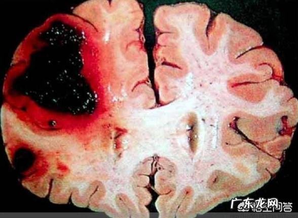 脑溢血的七个前兆信号,早知道或许可保命,具体指什么