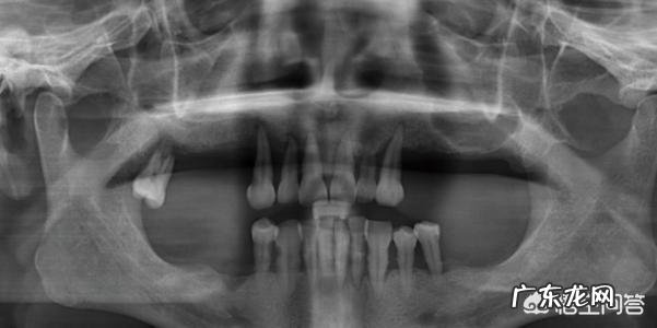 自己的下牙大部分都松动了，这是怎么回事