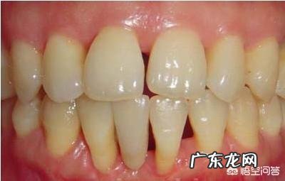 自己的下牙大部分都松动了，这是怎么回事