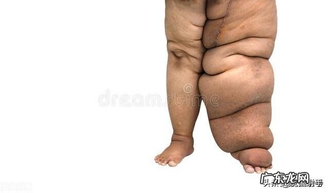 糖尿病人如何看出尿中出现酮体