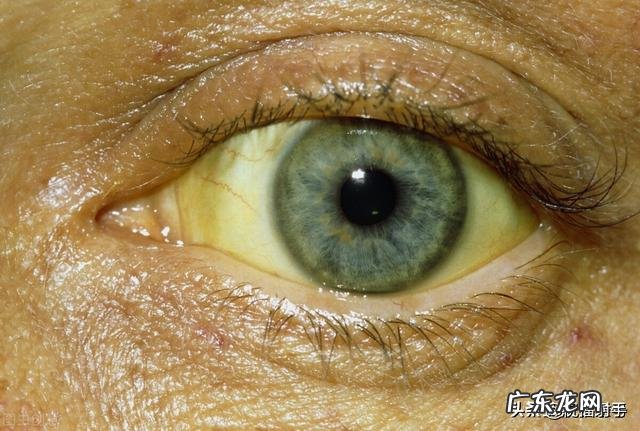 糖尿病人如何看出尿中出现酮体