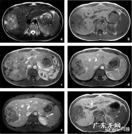 甲胎蛋白为阴性等于没有肝癌吗
