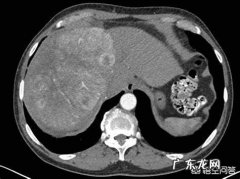 甲胎蛋白为阴性等于没有肝癌吗