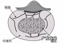 腰椎突出烤电有作用吗烤多长时间为好