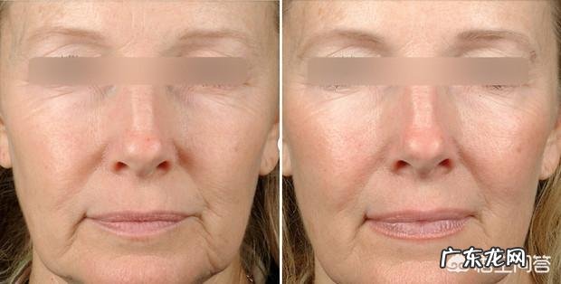 脸上去皱纹最好的方法是什么