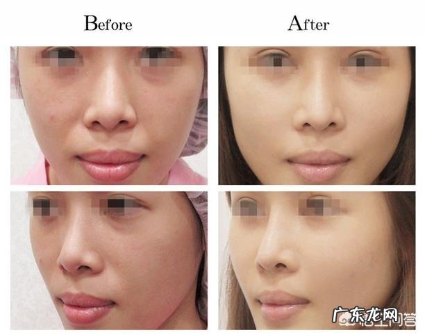 脸上去皱纹最好的方法是什么