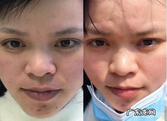 为什么打过水光针后反而会感觉更干打完水光针应该怎么护肤