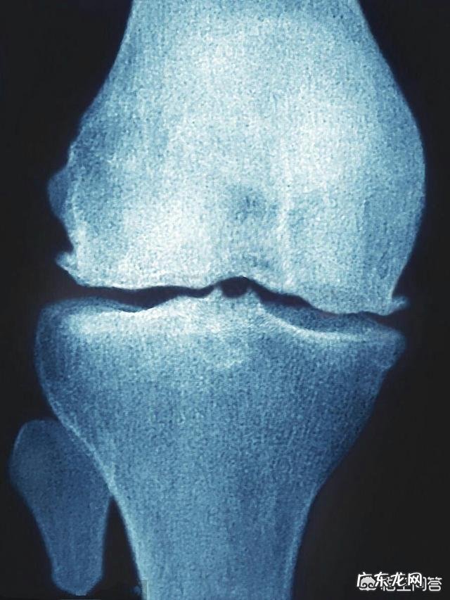如何能更好的护理膝关节炎患者