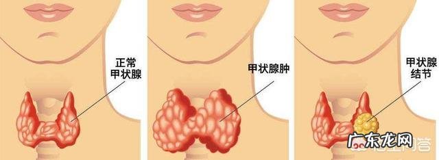 甲状腺结节会影响减脂效果吗