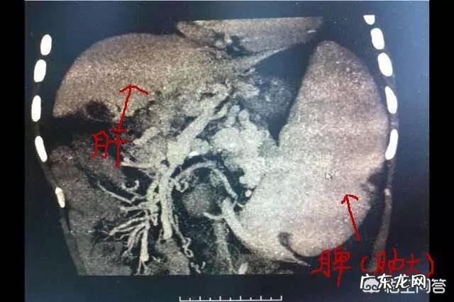 乙肝病人为什么一般伴随有脾肿大