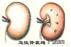 肾功能衰竭的时候为什么会有大量蛋白尿排出而同时伴有高钾血症