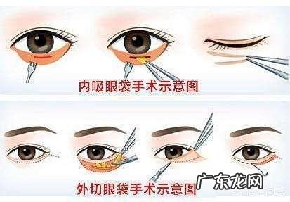 学生眼袋黑眼圈很重,应该怎样祛除