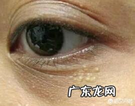 学生眼袋黑眼圈很重,应该怎样祛除