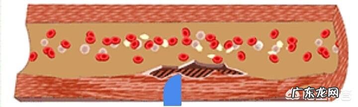 学生眼袋黑眼圈很重,应该怎样祛除