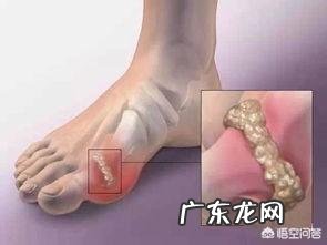 吃西药把尿酸降下来了,但痛风还是会发作,这是为什么