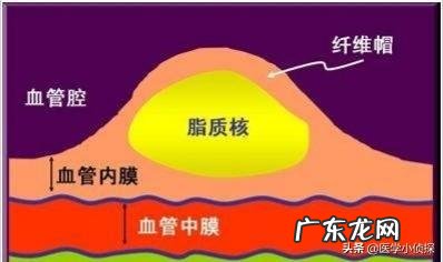 如何区分“硬斑块”、“软斑块”和“混合斑块”