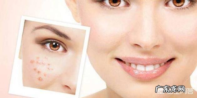 白糖真的可以去掉痘印吗?