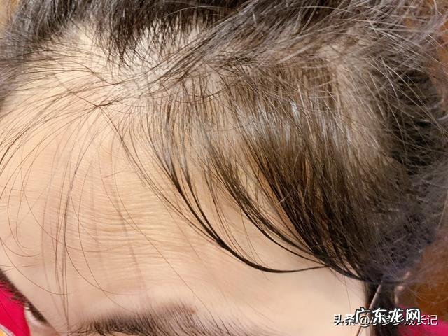 我产后脱发特别严重,有什么办法