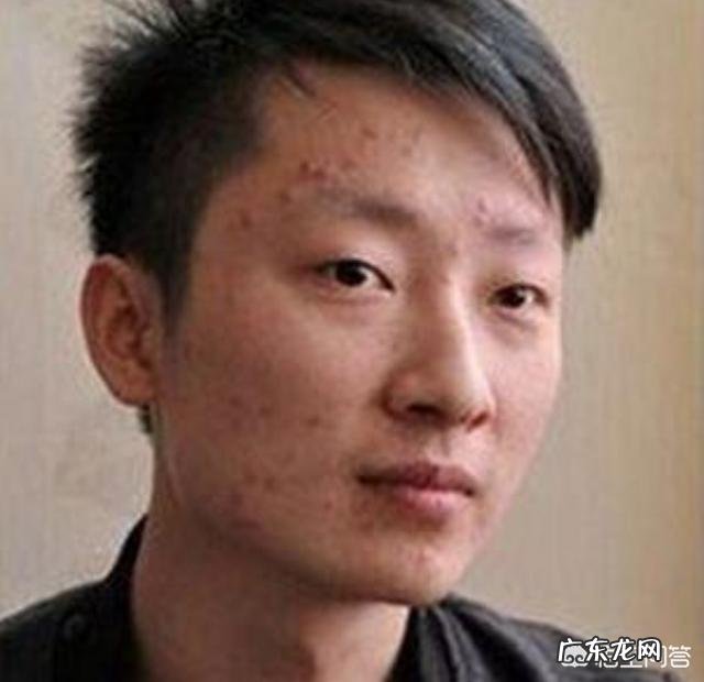 男人脸上有痘痘、痘印、痘坑!用什么方法或者洗面奶可以清除掉?