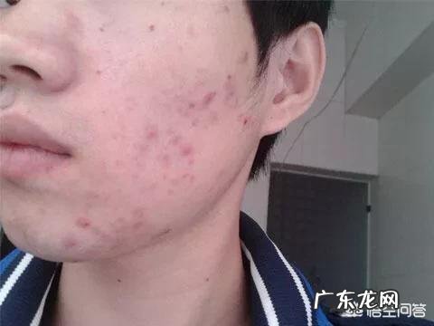 男人脸上有痘痘、痘印、痘坑!用什么方法或者洗面奶可以清除掉?