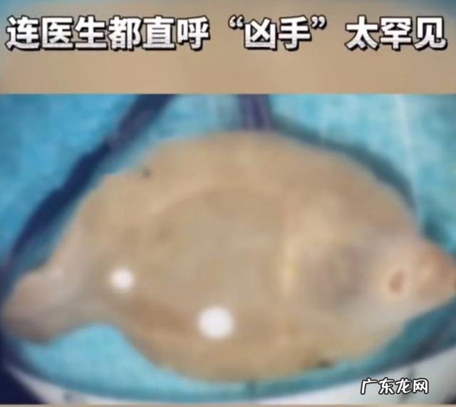 女子体内为何出现肝巨片型吸虫?