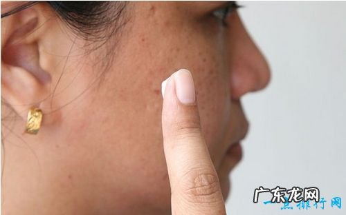 牙膏的十大奇妙用途 原来牙膏可以去除青春痘