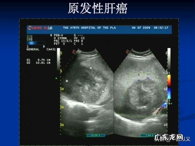 做什么检查可以发现早期肝癌