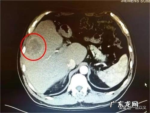 做什么检查可以发现早期肝癌