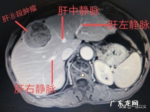 做什么检查可以发现早期肝癌