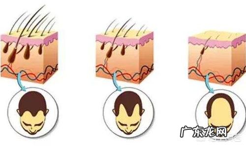 男人不到30脱发怎么办？