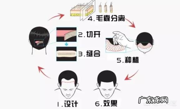 男人不到30脱发怎么办？