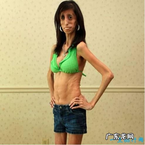 世界上最瘦的人 极端减肥造成体重仅20公斤