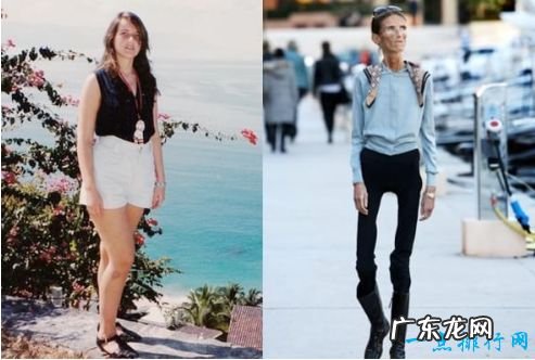 世界上最瘦的人 极端减肥造成体重仅20公斤