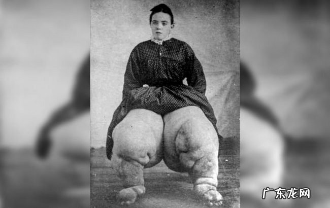 世界上十大最恶心的寄生虫 非常恶心恐怖