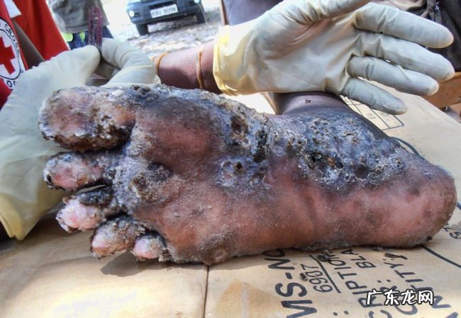 世界上十大最恶心的寄生虫 非常恶心恐怖