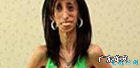 世界上最瘦的人体重只有27公斤