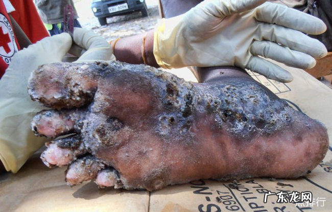 全球十大最恐怖的寄生虫 胆小勿入真的很渗人