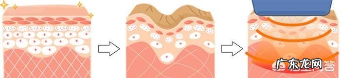 电波拉皮的注意事项有哪些呢?