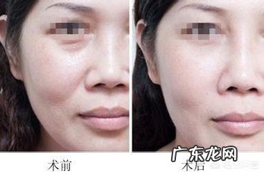 电波拉皮的注意事项有哪些呢?