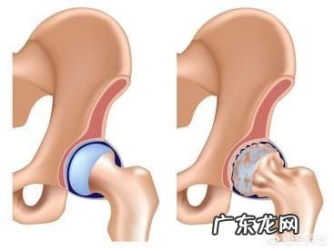 什么是骨性关节炎如何预防