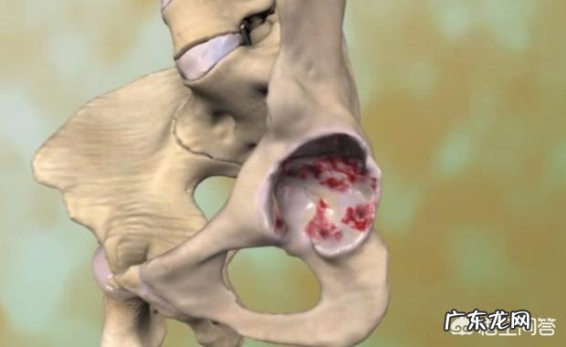 什么是骨性关节炎如何预防