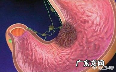 什么是急性胃炎?